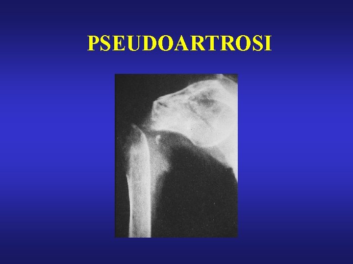 PSEUDOARTROSI 