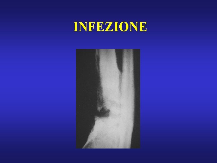 INFEZIONE 