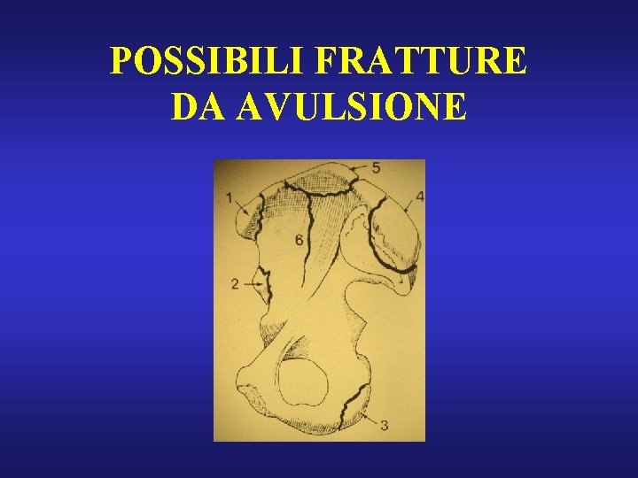 POSSIBILI FRATTURE DA AVULSIONE 