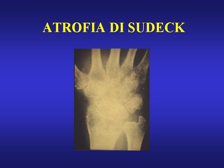 ATROFIA DI SUDECK 