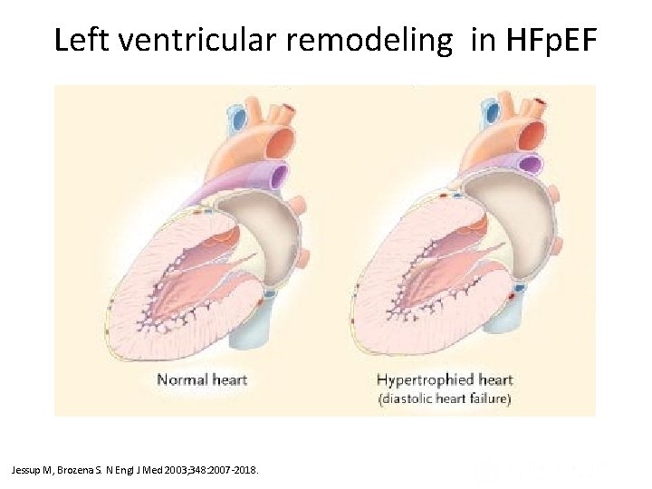 Ventricular Remodeling after Infarction (Panel A) and in Diastolic and Systolic Heart Failure (Panel