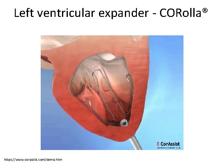 Left ventricular expander - CORolla® Ventricular Remodeling after Infarction (Panel A) and in Diastolic