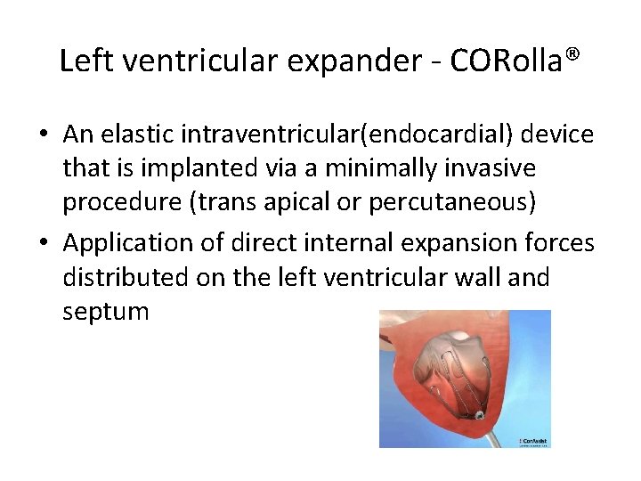 Left ventricular expander - CORolla® • An elastic intraventricular(endocardial) device that is implanted via Left ventricular expander - CORolla® • An elastic intraventricular(endocardial) device that is implanted via