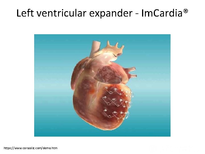 Ventricular Remodeling after Infarction (Panel A) and in Diastolic and Systolic Heart Failure (Panel Ventricular Remodeling after Infarction (Panel A) and in Diastolic and Systolic Heart Failure (Panel