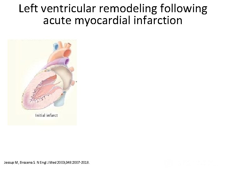 Left ventricular remodeling following acute myocardial infarction Ventricular Remodeling after Infarction (Panel A) and