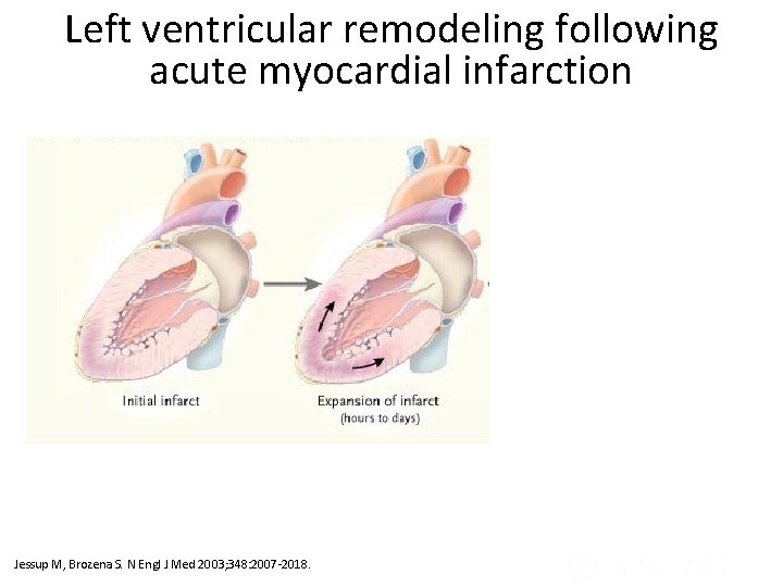 Left ventricular remodeling following acute myocardial infarction Ventricular Remodeling after Infarction (Panel A) and