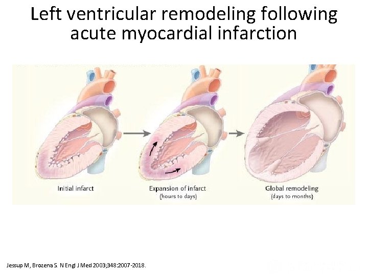 Left ventricular remodeling following acute myocardial infarction Ventricular Remodeling after Infarction (Panel A) and Left ventricular remodeling following acute myocardial infarction Ventricular Remodeling after Infarction (Panel A) and