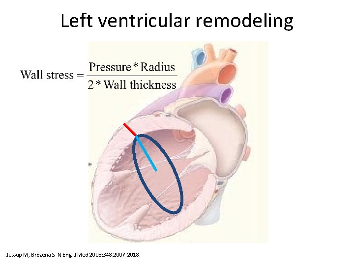 Left ventricular remodeling Ventricular Remodeling after Infarction (Panel A) and in Diastolic and Systolic