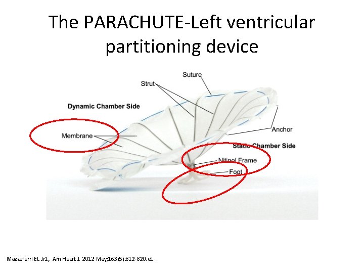 The PARACHUTE-Left ventricular partitioning device Mazzaferri EL Jr 1, . Am Heart J. 2012 The PARACHUTE-Left ventricular partitioning device Mazzaferri EL Jr 1, . Am Heart J. 2012