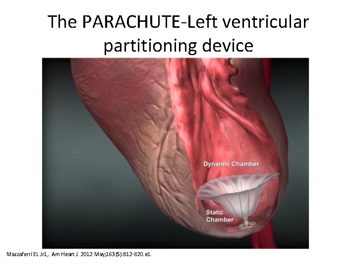 The PARACHUTE-Left ventricular partitioning device Mazzaferri EL Jr 1, . Am Heart J. 2012