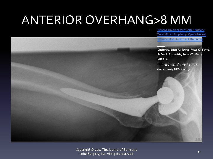 ANTERIOR OVERHANG>8 MM • Iliopsoas Impingement After Primary Total Hip Arthroplasty: Operative and Nonoperative