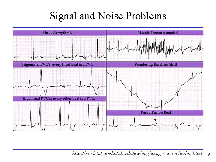 Signal and Noise Problems http: //medstat. med. utah. edu/kw/ecg/image_index/index. html 6 