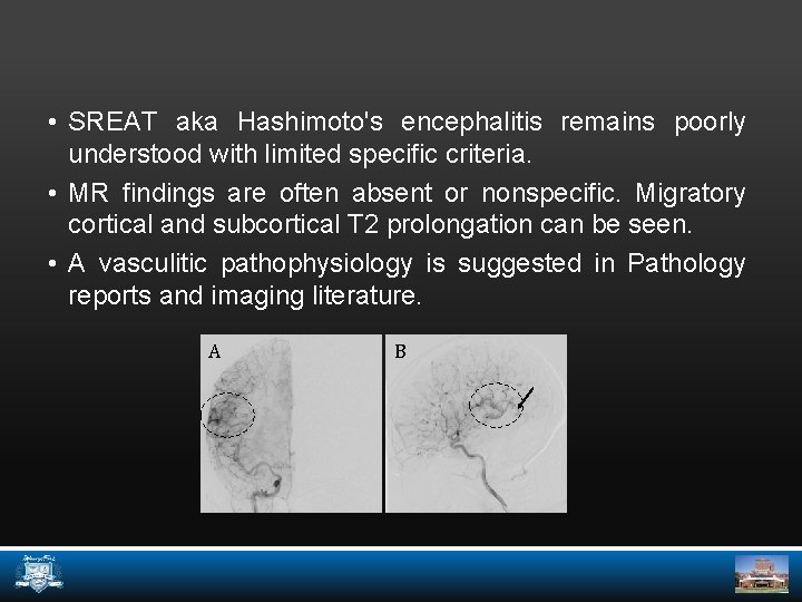  • SREAT aka Hashimoto's encephalitis remains poorly understood with limited specific criteria. •