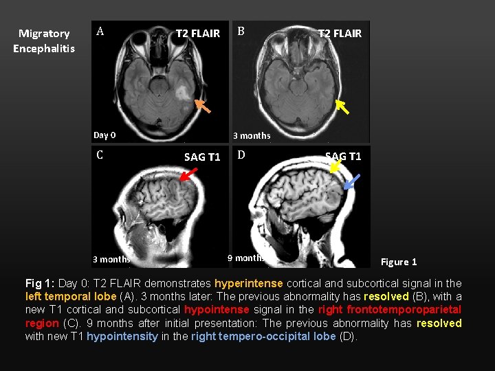 Migratory Encephalitis A T 2 FLAIR Day 0 C 3 months B T 2