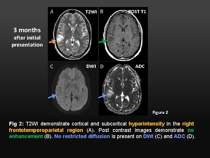 A T 2 WI B POST T 1 C DWI D ADC 3 months