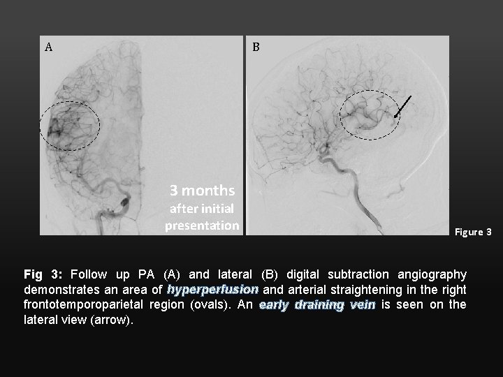 A B 3 months after initial presentation Figure 3 Fig 3: Follow up PA
