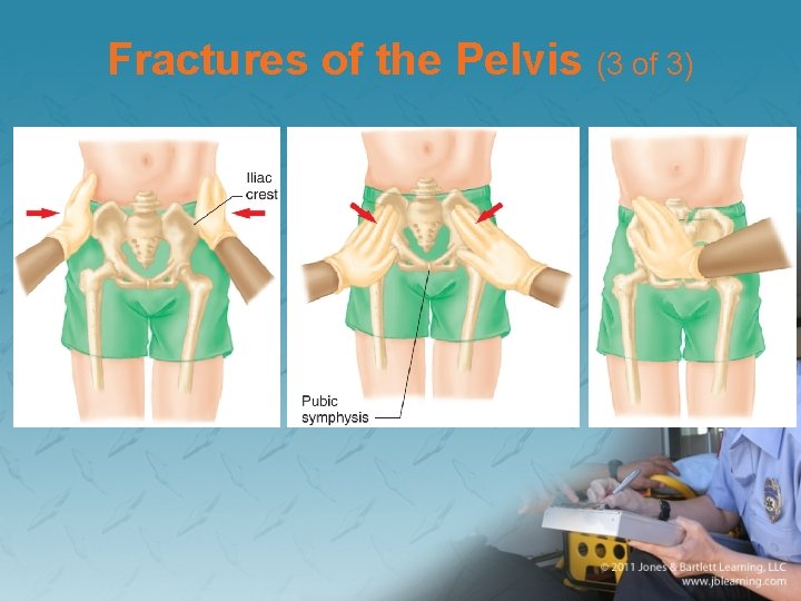 Fractures of the Pelvis (3 of 3) 