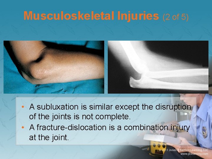 Musculoskeletal Injuries (2 of 5) • A subluxation is similar except the disruption of