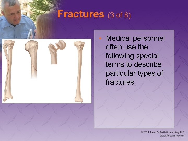 Fractures (3 of 8) • Medical personnel often use the following special terms to