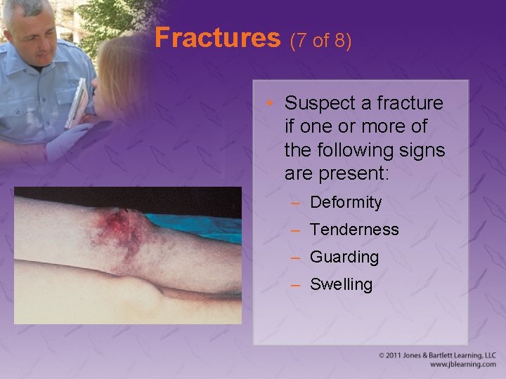 Fractures (7 of 8) • Suspect a fracture if one or more of the