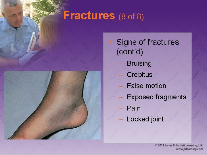 Fractures (8 of 8) • Signs of fractures (cont’d) – Bruising – Crepitus –