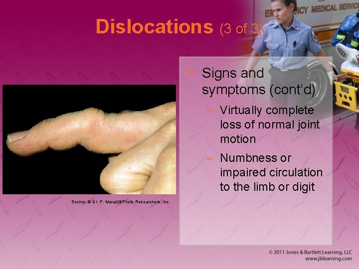 Dislocations (3 of 3) • Signs and symptoms (cont’d) – Virtually complete loss of