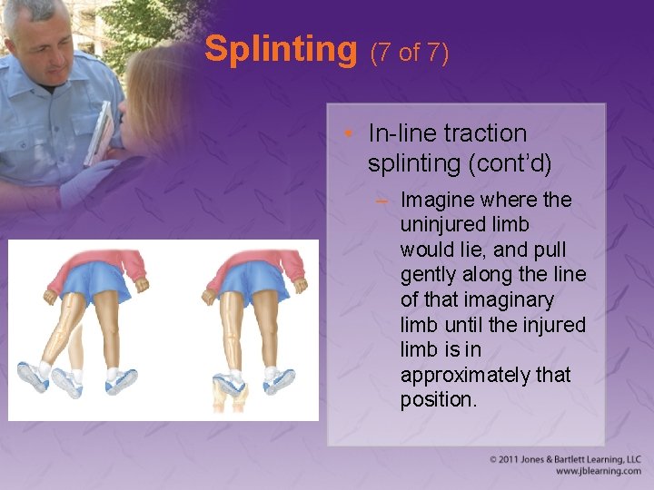 Splinting (7 of 7) • In-line traction splinting (cont’d) – Imagine where the uninjured