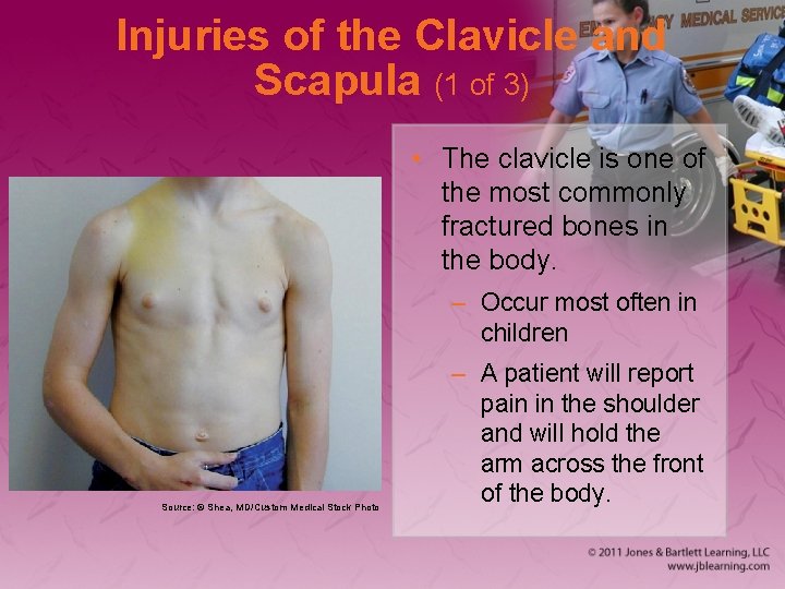 Injuries of the Clavicle and Scapula (1 of 3) • The clavicle is one