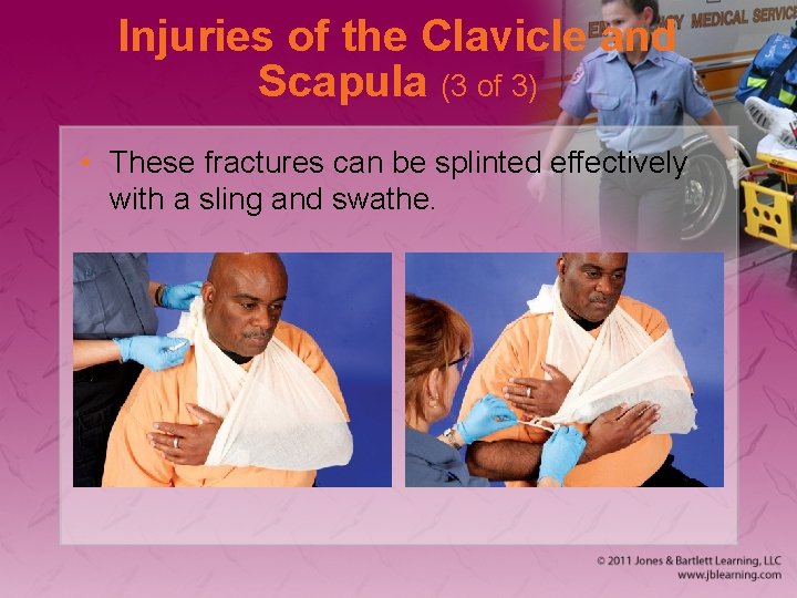 Injuries of the Clavicle and Scapula (3 of 3) • These fractures can be