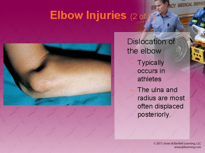 Elbow Injuries (2 of 5) • Dislocation of the elbow – Typically occurs in