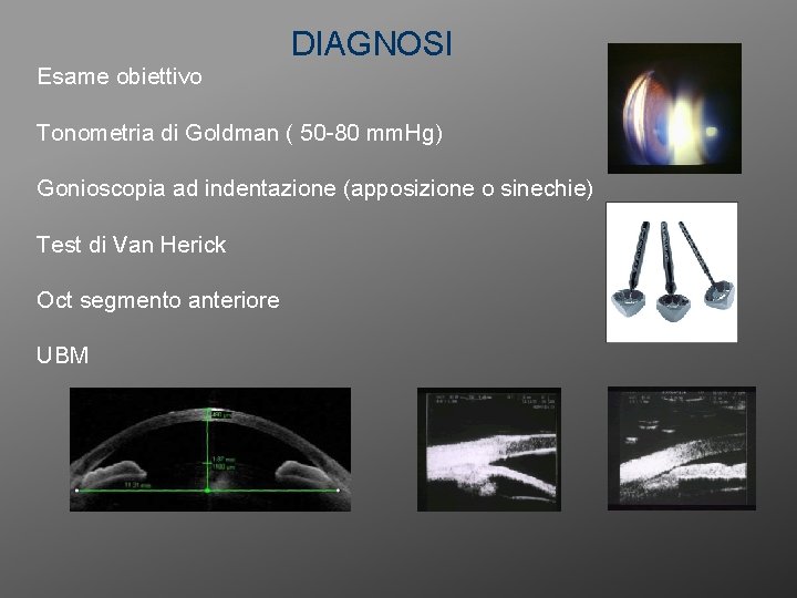 DIAGNOSI Esame obiettivo Tonometria di Goldman ( 50 -80 mm. Hg) Gonioscopia ad indentazione