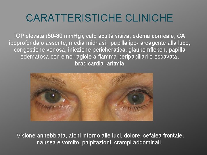 CARATTERISTICHE CLINICHE IOP elevata (50 -80 mm. Hg), calo acuità visiva, edema corneale, CA