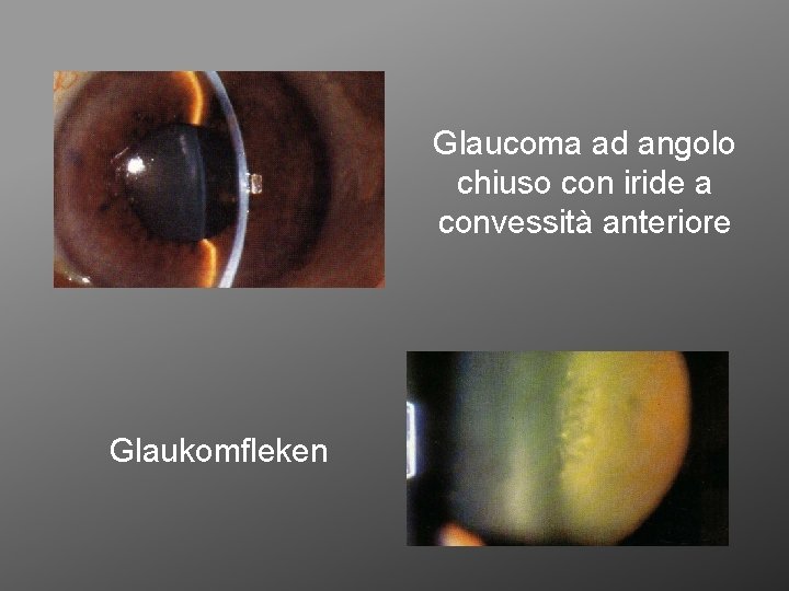 Glaucoma ad angolo chiuso con iride a convessità anteriore Glaukomfleken 