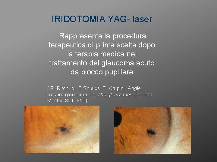 IRIDOTOMIA YAG- laser Rappresenta la procedura terapeutica di prima scelta dopo la terapia medica