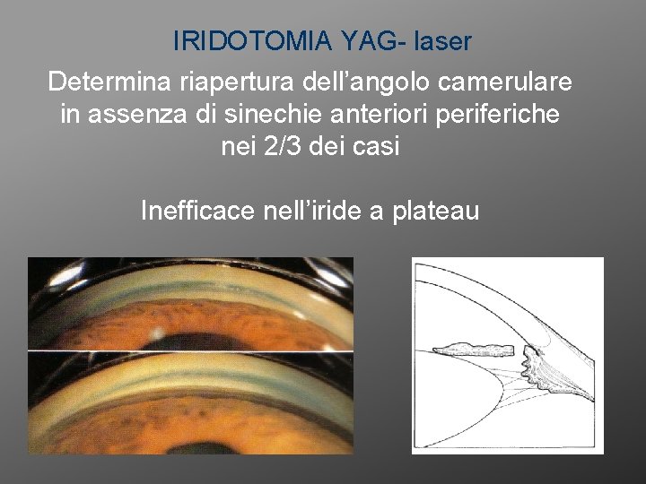 IRIDOTOMIA YAG- laser Determina riapertura dell’angolo camerulare in assenza di sinechie anteriori periferiche nei