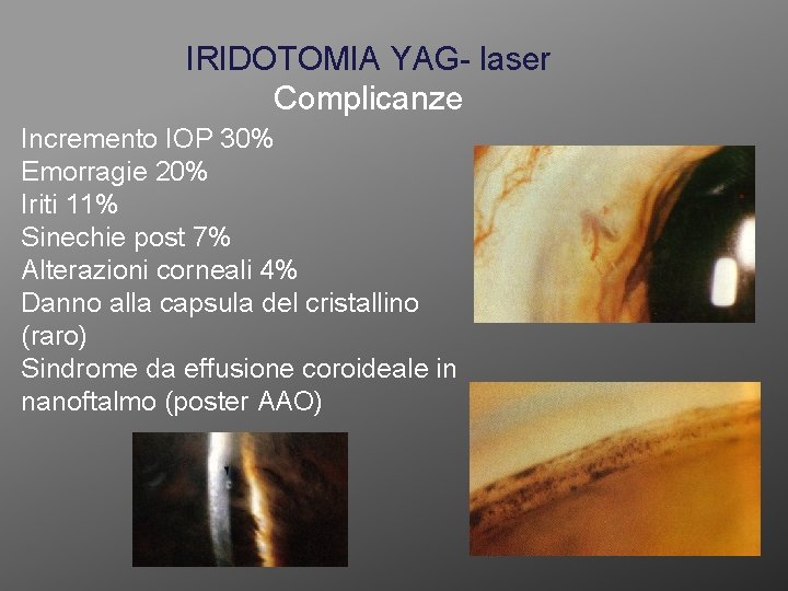 IRIDOTOMIA YAG- laser Complicanze Incremento IOP 30% Emorragie 20% Iriti 11% Sinechie post 7%