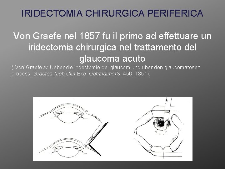 IRIDECTOMIA CHIRURGICA PERIFERICA Von Graefe nel 1857 fu il primo ad effettuare un iridectomia