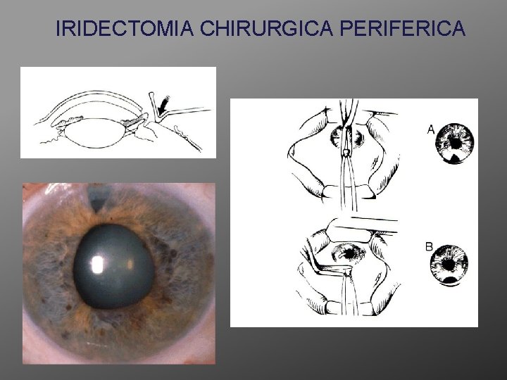 IRIDECTOMIA CHIRURGICA PERIFERICA 