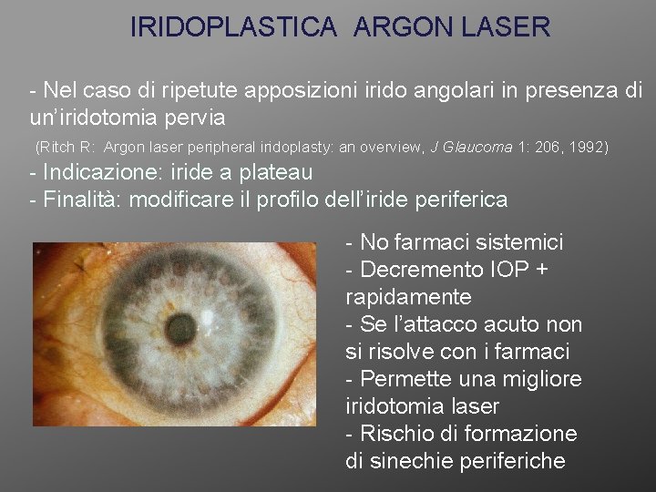 IRIDOPLASTICA ARGON LASER - Nel caso di ripetute apposizioni irido angolari in presenza di