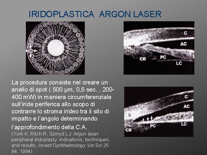 IRIDOPLASTICA ARGON LASER La procedura consiste nel creare un anello di spot ( 500