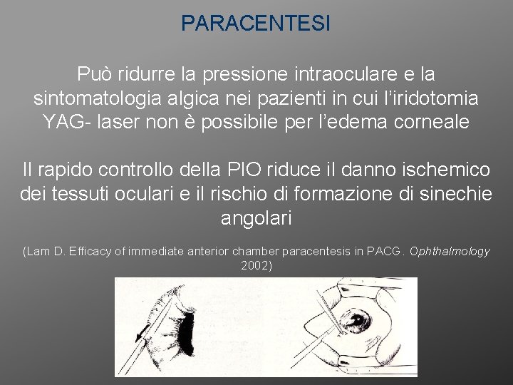 PARACENTESI Può ridurre la pressione intraoculare e la sintomatologia algica nei pazienti in cui