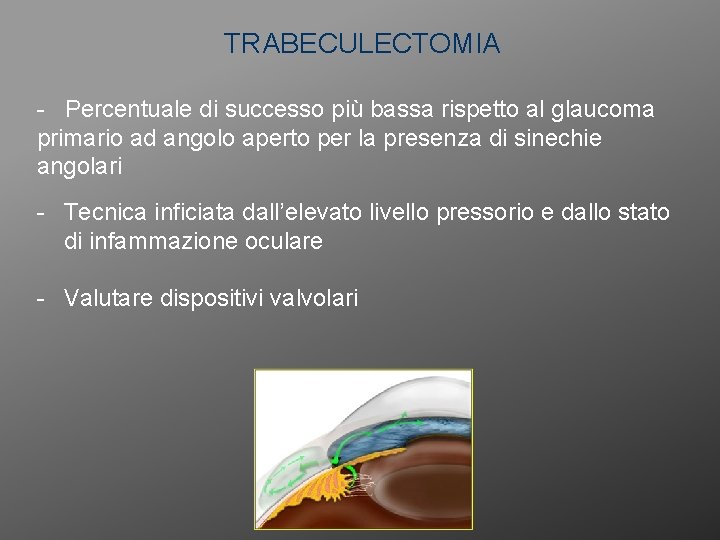 TRABECULECTOMIA - Percentuale di successo più bassa rispetto al glaucoma primario ad angolo aperto