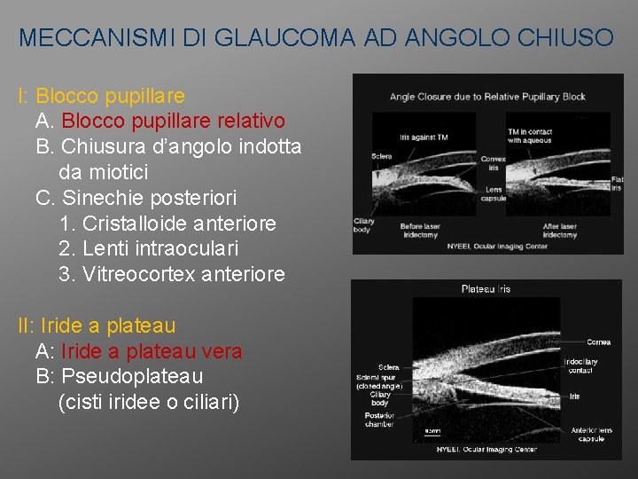 MECCANISMI DI GLAUCOMA AD ANGOLO CHIUSO I: Blocco pupillare A. Blocco pupillare relativo B.