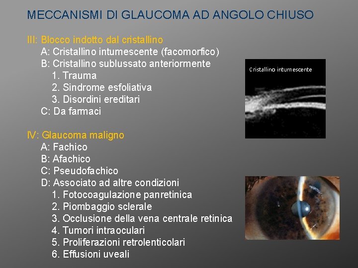 MECCANISMI DI GLAUCOMA AD ANGOLO CHIUSO III: Blocco indotto dal cristallino A: Cristallino intumescente