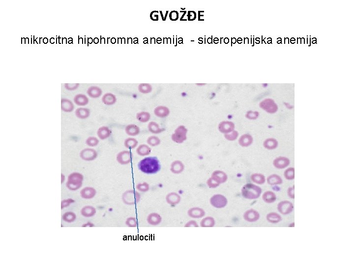 GVOŽĐE mikrocitna hipohromna anemija - sideropenijska anemija anulociti 