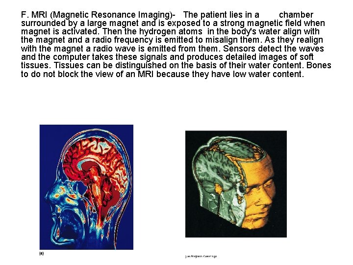 F. MRI (Magnetic Resonance Imaging)- The patient lies in a chamber surrounded by a