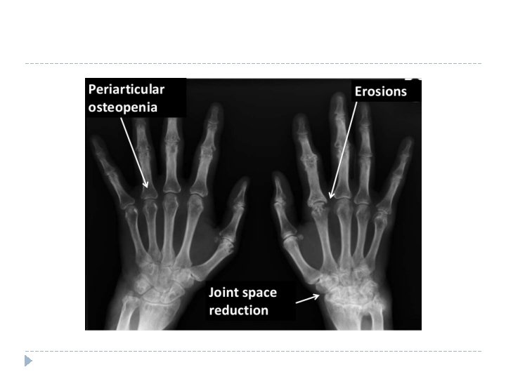Diagnosis and differential diagnosis of rheumatoid arthritis Update