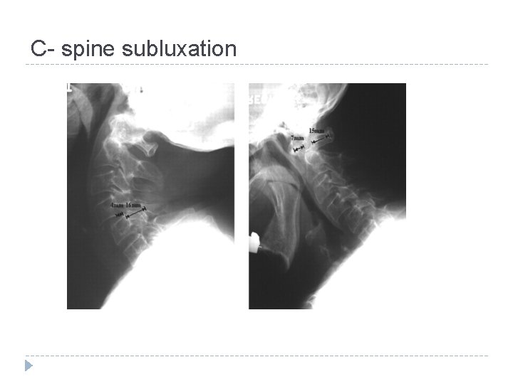 C- spine subluxation 