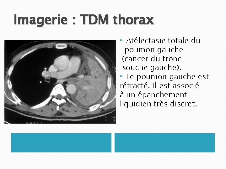 Imagerie : TDM thorax Atélectasie totale du poumon gauche (cancer du tronc souche gauche).