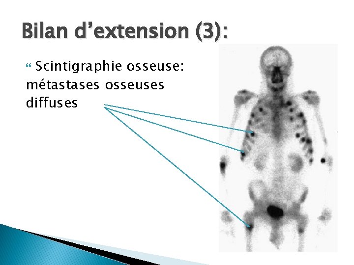 Bilan d’extension (3): Scintigraphie osseuse: métastases osseuses diffuses 